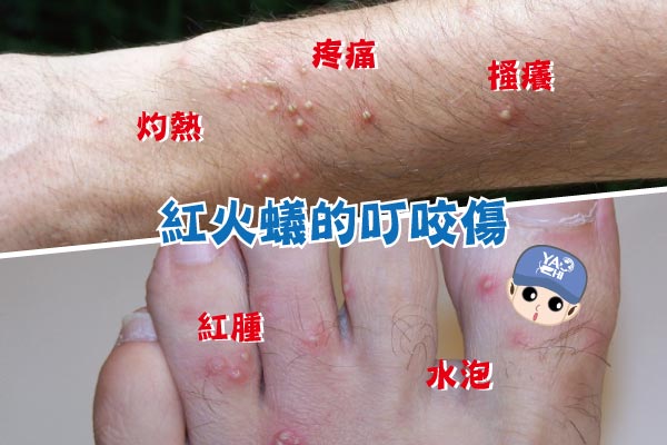 入侵紅火蟻 咬傷 水泡